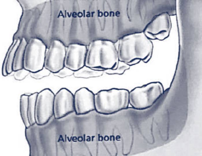 Dentoalveolar