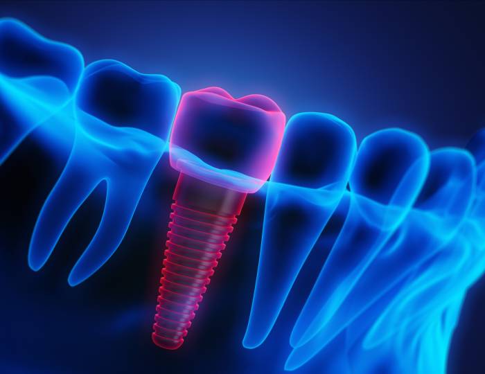 Close-up of a dental implant with crown in the lower jaw against a dark background - X Ray 3D illustration
