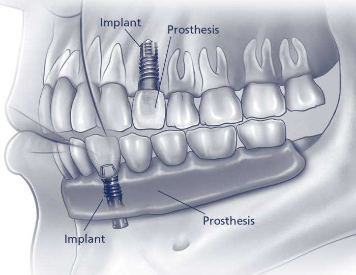 implants