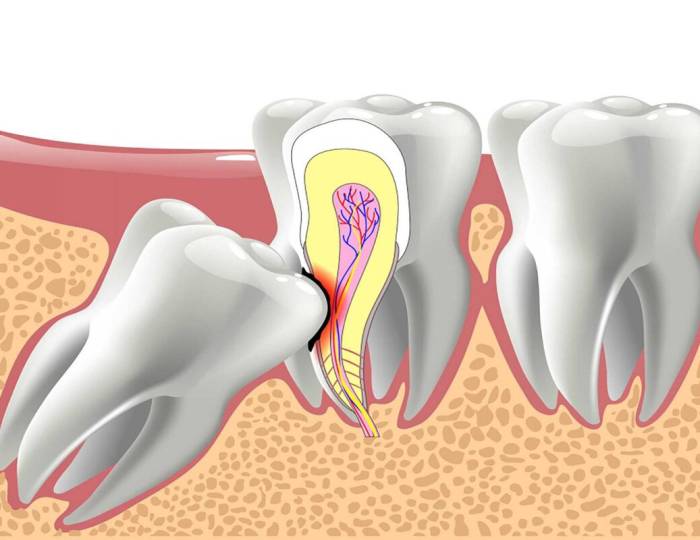 wisdom-teeth-example-02